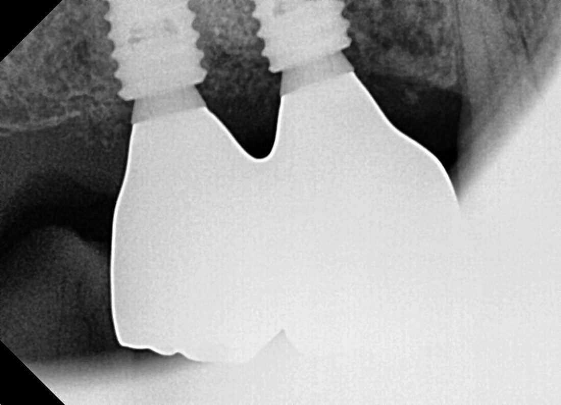 위 어금니 임플란트 보철물을 장착한 뒤 촬영한 치근단 방사선 사진